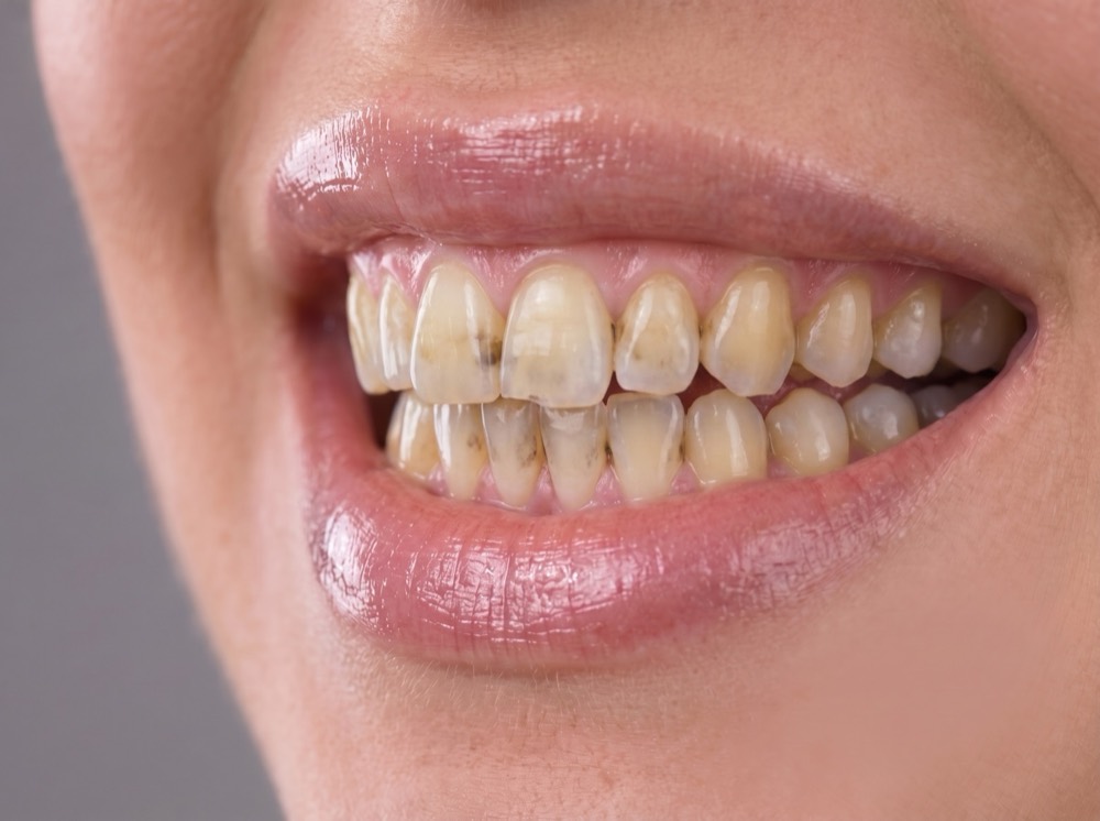 Smile before treatment